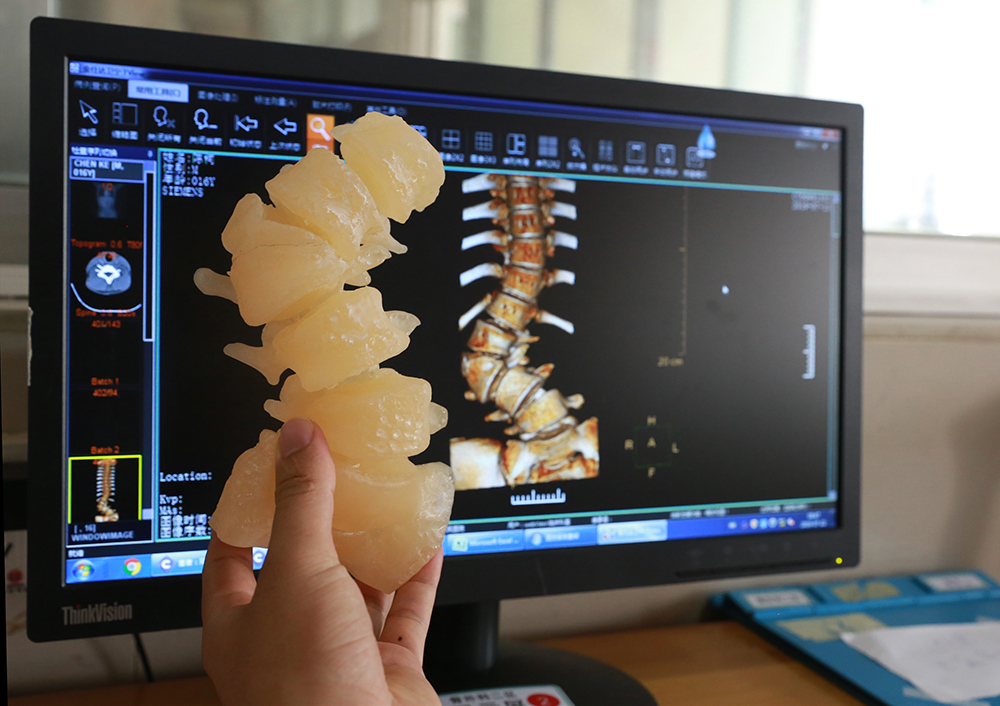 脊柱侧弯术前3d打印建模.jpg
